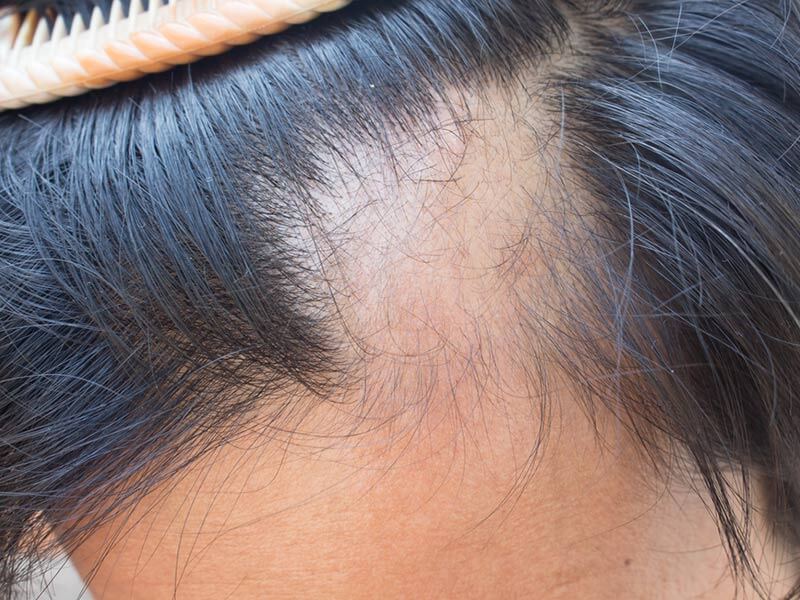 Zahl der Haartransplantationen gestiegen